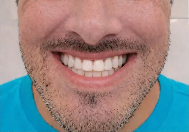 beforeAfter.cases.undefined.title before treatment — full arch implant service — MAP Dental Center Houston