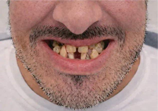 beforeAfter.cases.undefined.title after treatment — full arch implant service — MAP Dental Center Houston