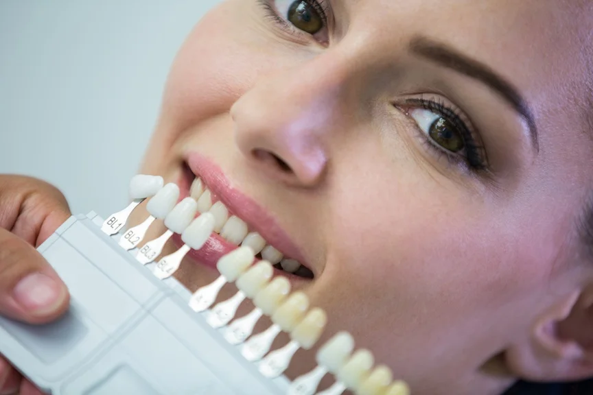 Cosmetic dentistry shade guide held beside a patient smile for veneer color selection at MAP Dental Center Houston on Greenhouse Rd.