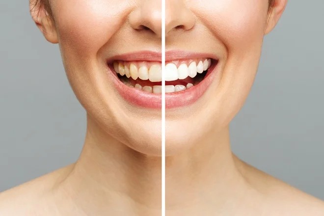 Before and after professional teeth whitening split comparison at MAP Dental Center Houston on Greenhouse Rd.