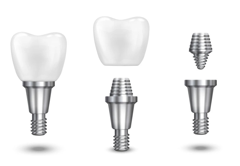 MAP Dental implants patient smile West Houston — MAP Dental Center Houston Greenhouse Rd.