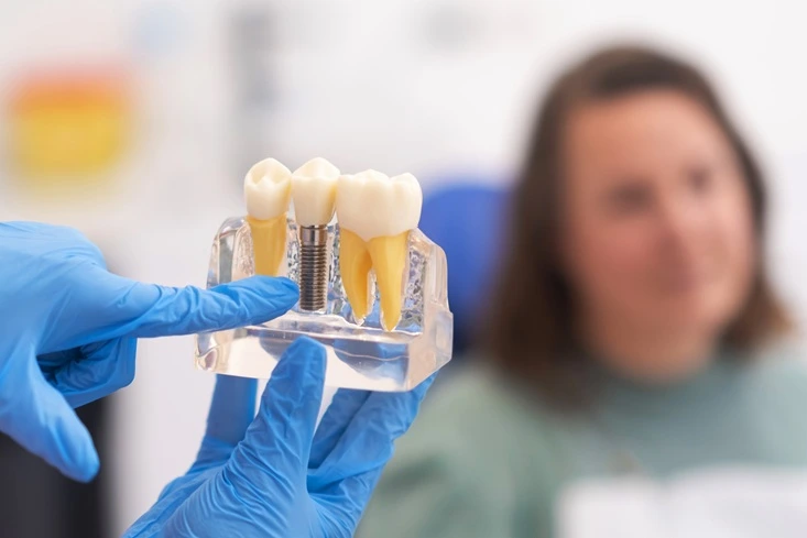 MAP Dental implant education model West Houston — clinician at MAP Dental Center Houston.