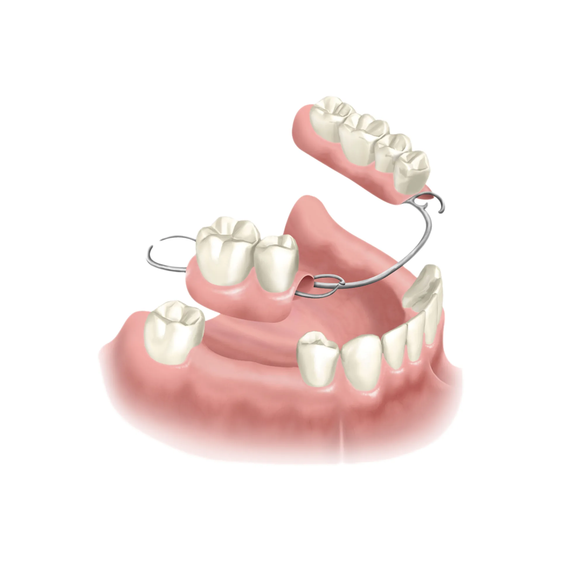 MAP Dental partial denture illustration West Houston — MAP Dental Center Houston.