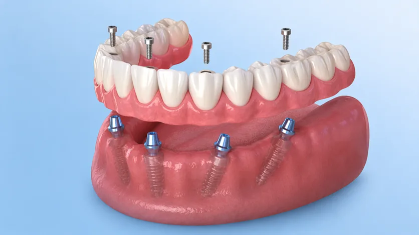 Educational full-arch implant model showing four implant posts and fixed prosthesis — MAP Dental Center Houston.