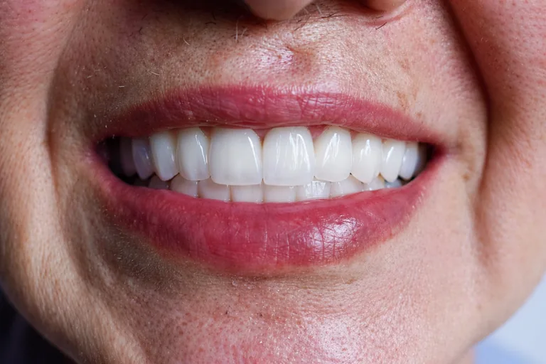 Before-and-after smile transformation for a female full-arch implant patient — MAP Dental Center Houston — after