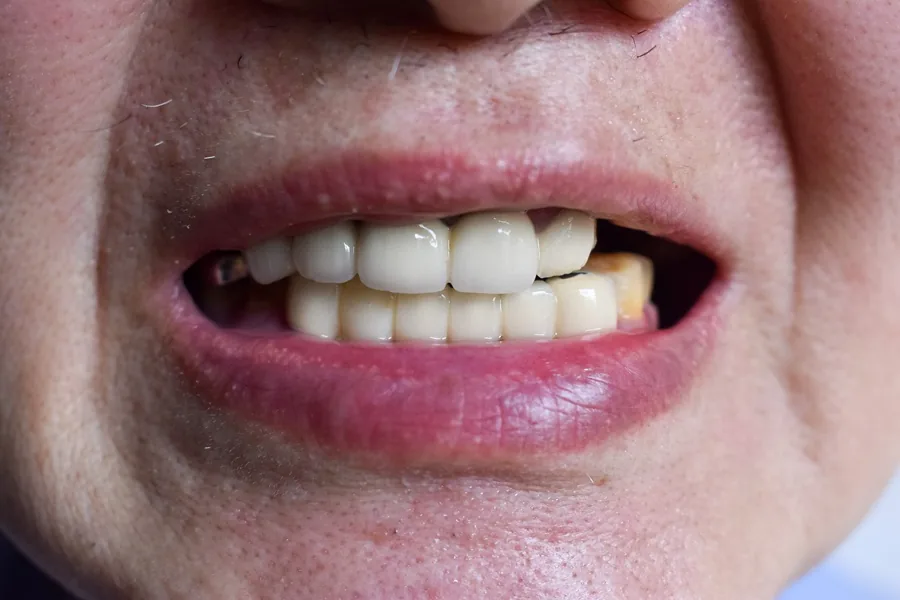 Before-and-after smile transformation for a female full-arch implant patient — MAP Dental Center Houston — before