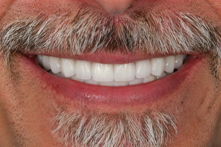 Before-and-after All-on-4 zirconia bridge case for a male patient — MAP Dental Center Houston — after