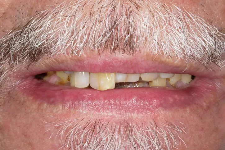 Before-and-after All-on-4 zirconia bridge case for a male patient — MAP Dental Center Houston — before