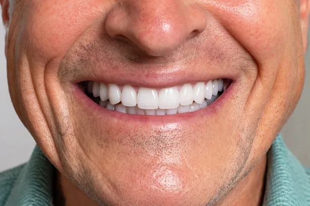 Before-and-after implant-supported full smile for a male patient with wear — MAP Dental Center Houston — after