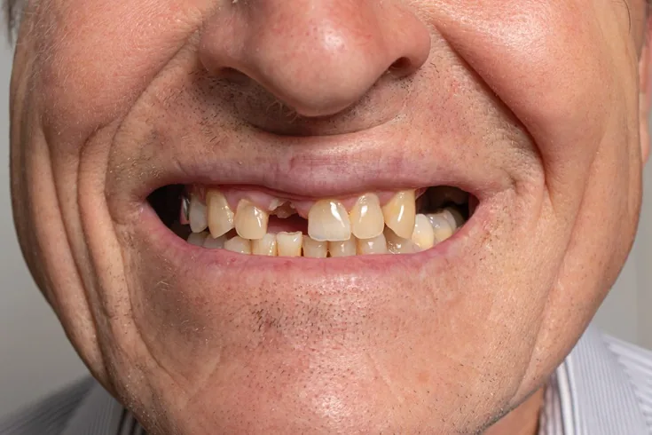 Before-and-after implant-supported full smile for a male patient with wear — MAP Dental Center Houston — before