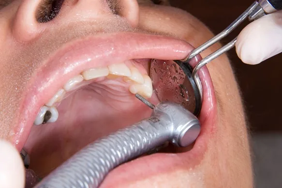 MAP Dental rehabilitation planning West Houston — MAP Dental Center Houston.