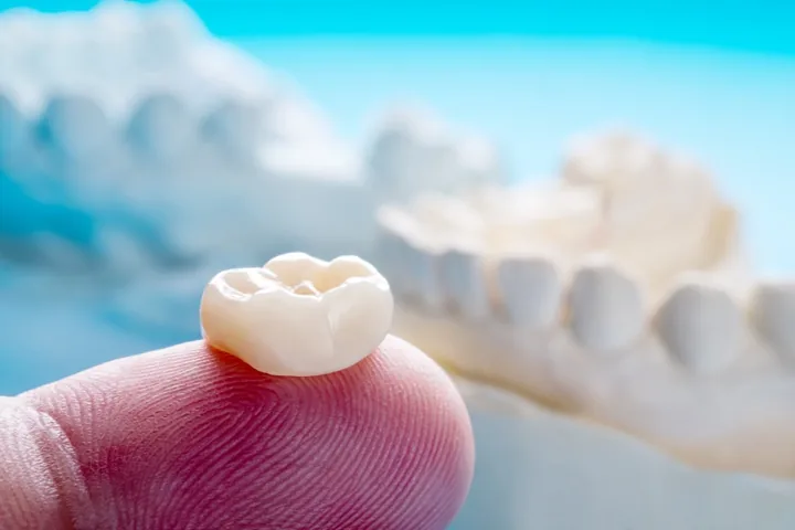 MAP Dental crown restoration West Houston — MAP Dental Center Houston.