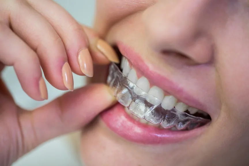 MAP Dental clear aligner therapy West Houston — MAP Dental Center Houston.