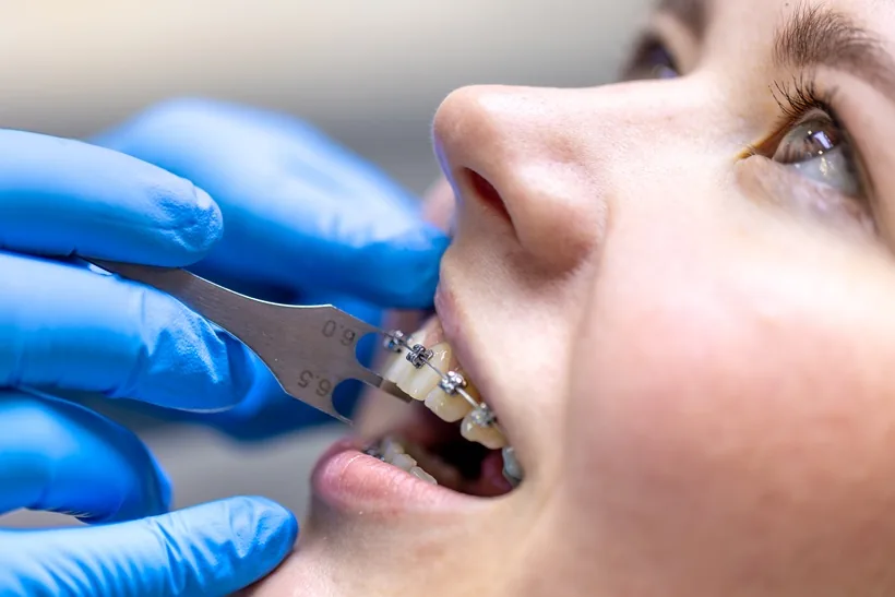 MAP Dental traditional braces West Houston — MAP Dental Center Houston.