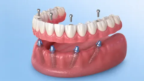 Full Arch Implants service photography — MAP Dental Center Houston, TX