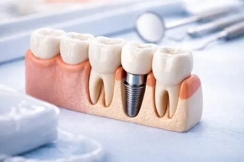 Dental Implants service photography — MAP Dental Center Houston, TX