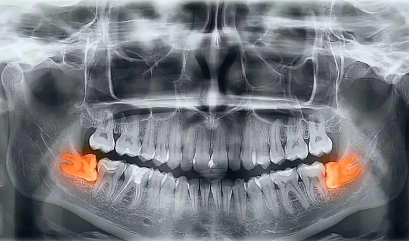 Wisdom tooth impaction diagram (mesial, distal, vertical, horizontal) — MAP Dental Center Houston patient education.